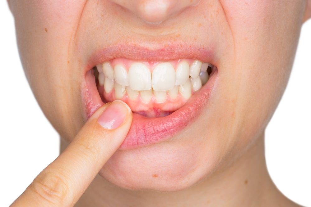 Comment j'ai guéri d'une parodontite forum : mon parcours vers la santé